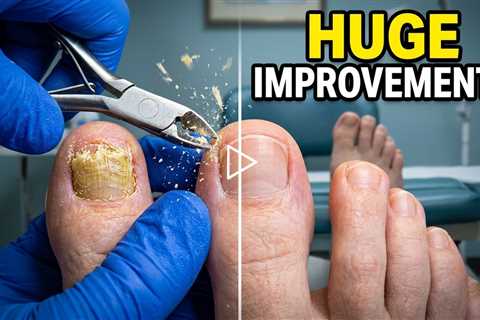 Follow-Up Toenail Treatment: How Much Improvement in One Month?