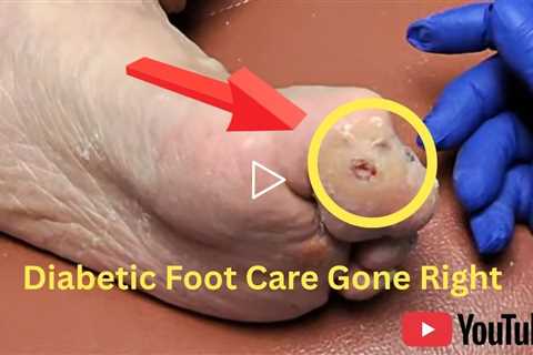Diabetic Foot Care Gone Right - Here's What Happens | Diabetic Wounds - Part 2