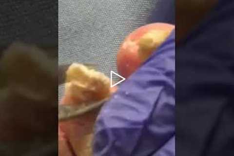 Satisfying Nail Removal With a Touching Backstory #healing #emotional