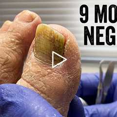 She Waited 9 MONTHS... Look at These Overgrown Toenails! 😲👣