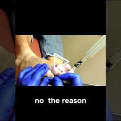 How Toe Deformities Cause Calluses and What Y